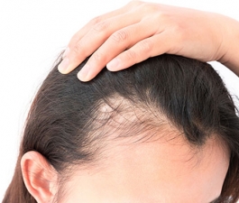 Calvície feminina: mitos e verdades sobre a queda de cabelo nas mulheres