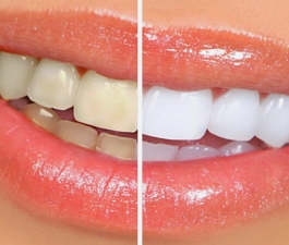 Seis alimentos que são péssimos para os dentes