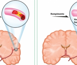 Entenda tudo sobre: Acidente Vascular Cerebral (AVC)