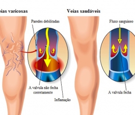 Cirurgião vascular do HCor aponta benefícios de nova técnica para tratamento de varizes