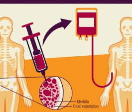 Mitos e verdades sobre o transplante de medula óssea