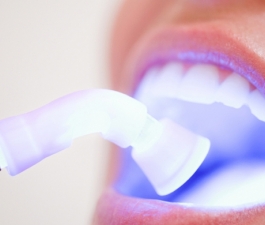 Clareamento dental enfraquece os dentes. Mito ou verdade?