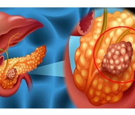 Oncologia do HCor aponta sinais que podem indicar câncer de pâncreas