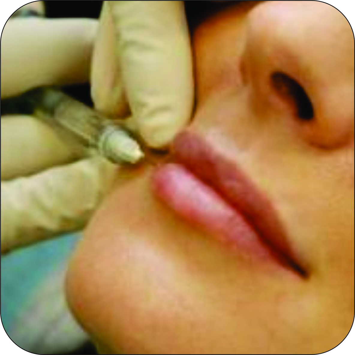 Saúde: Jovens aderem cada vez mais ao Botox