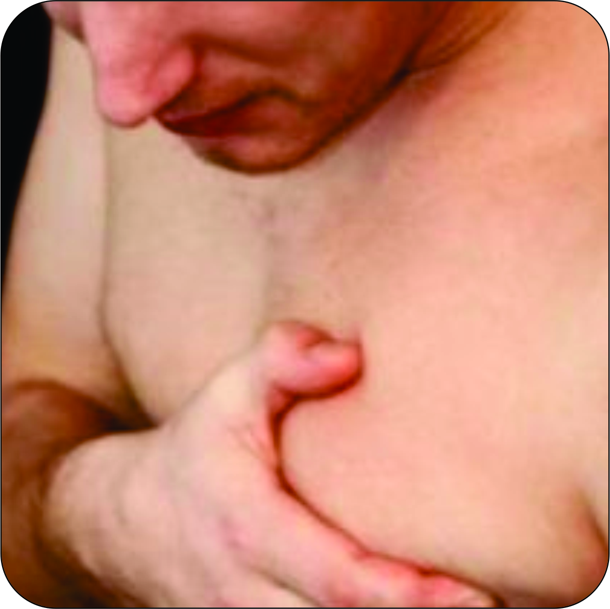 Plástica é benéfica para homens com ginecomastia