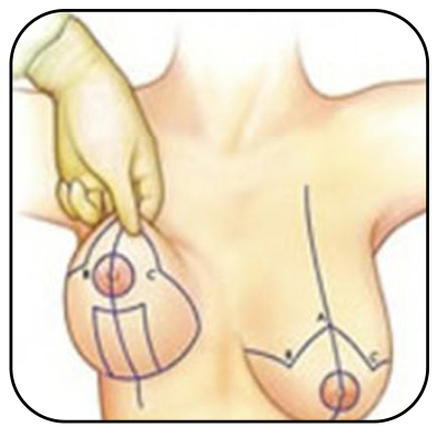 Mamoplastia de redução, uma questão de saúde