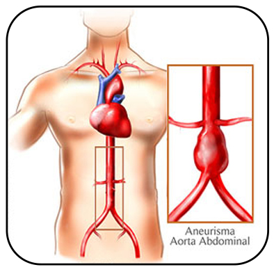 Semana Estadual de Prevenção e Combate ao Aneurisma da Aorta