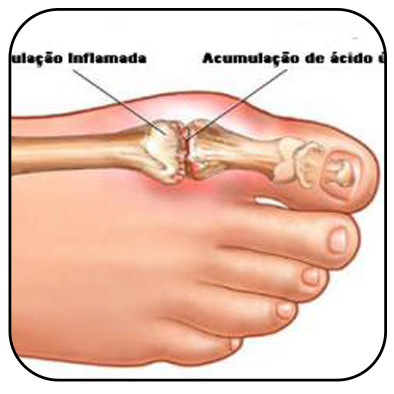 Confira dicas para evitar a gota