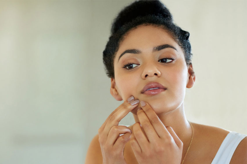 Dez mitos e verdades sobre a acne