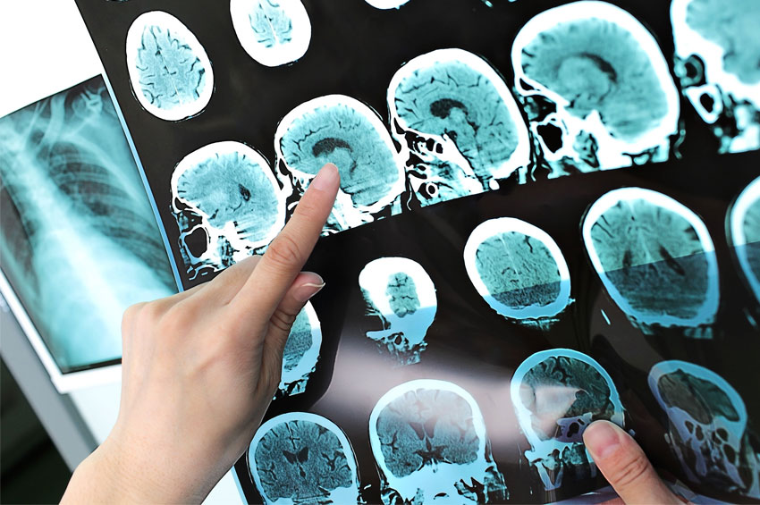 Entenda tudo sobre: Esclerose Múltipla