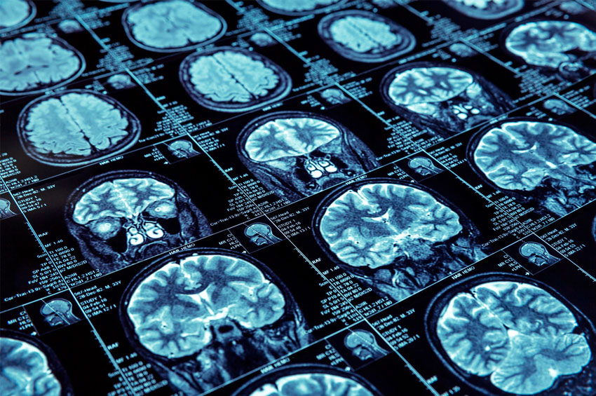 A diferença entre a epilepsia primária e secundária