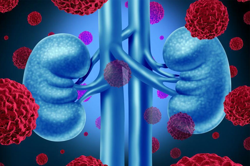 Carcinoma renal