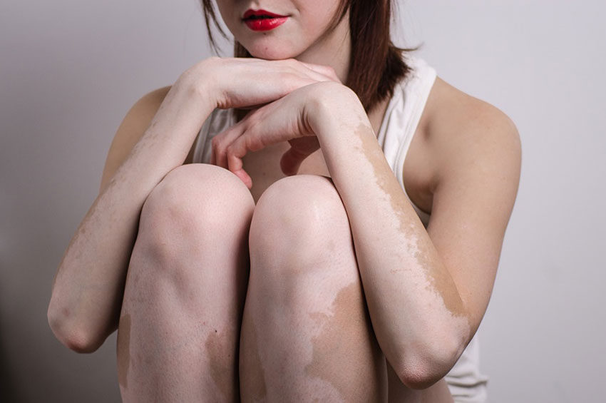 Vitiligo: doença que afeta a qualidade de vida