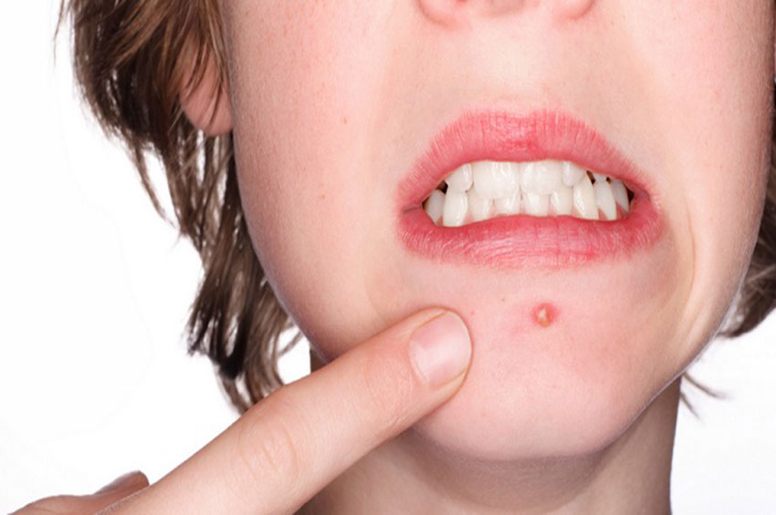 Guia de alimentação antiacne