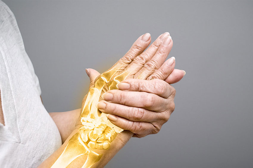 Especialistas explicam como evitar a Osteoporose 