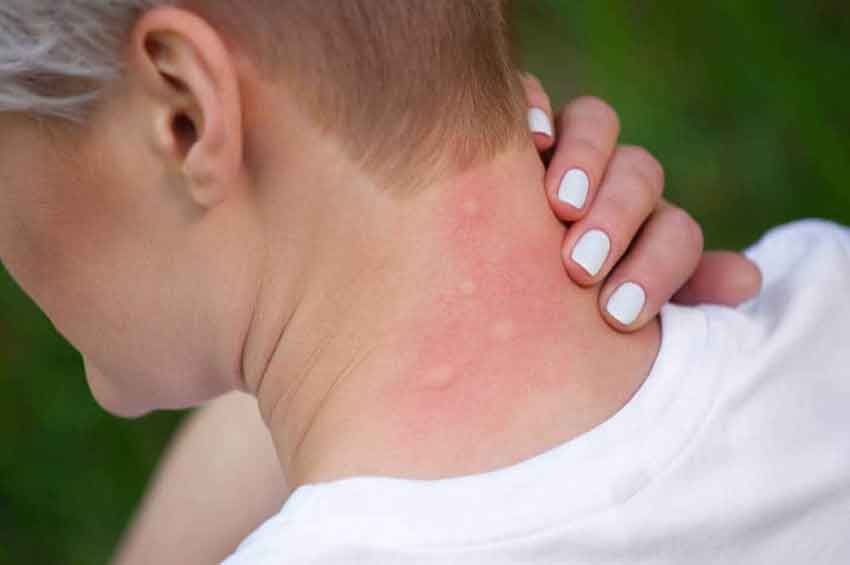 Chegada do verão pede cuidados e repelente é forte aliado contra o mosquito Aedes Aegypti