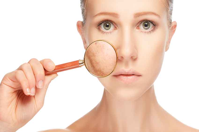 Acne é uma doença inflamatória e tem cura