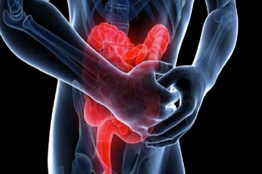 10 questões sobre as Doenças Inflamatórias Intestinais