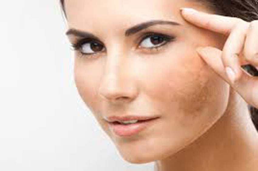 Verão pode piorar o melasma: saiba como evitar