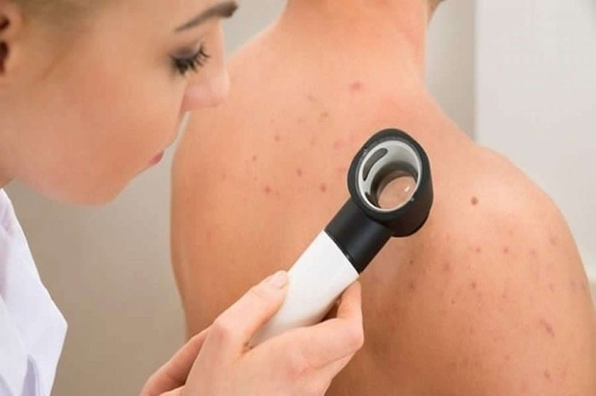 Fumantes com câncer de pele tipo melanoma têm 40% menos chances de sobrevivência, diz estudo