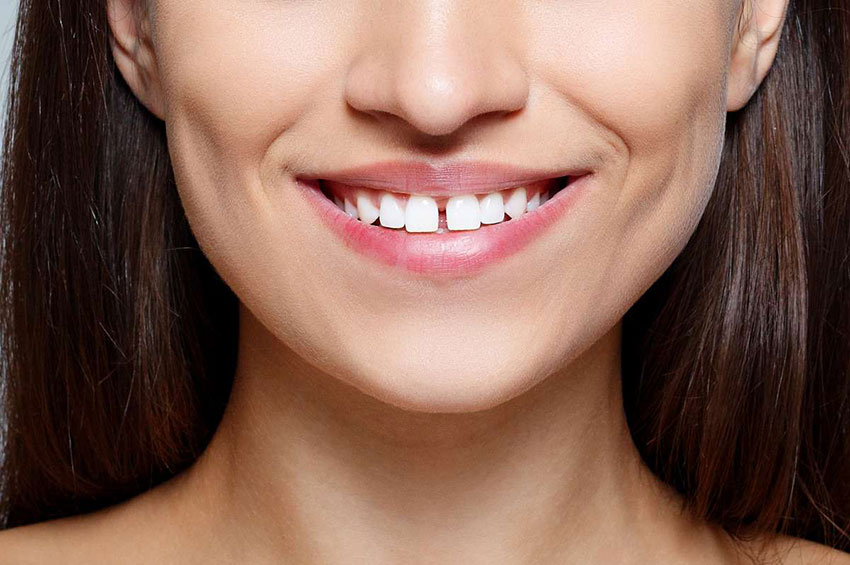 Diastema: principais características e formas de tratamento