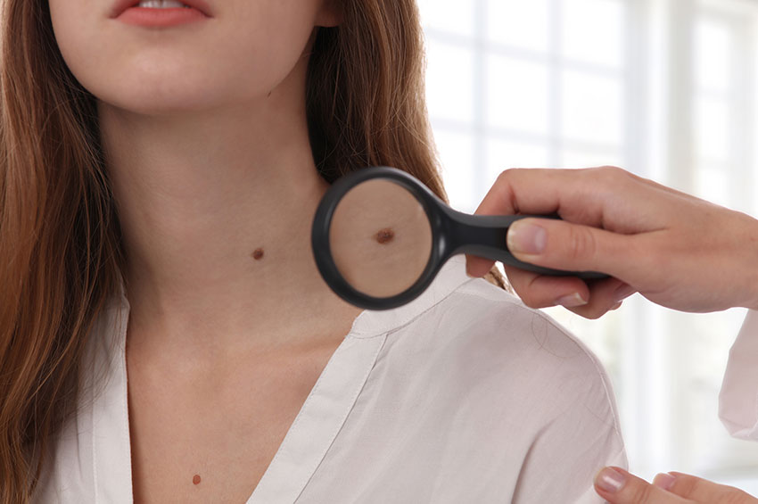 Dermatologista orienta sobre o surgimento de pintas vermelhas e manchas marrons pelo corpo