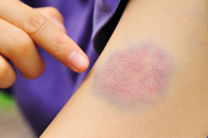 Hematoma que surge espontaneamente pode ser sinal de doenças