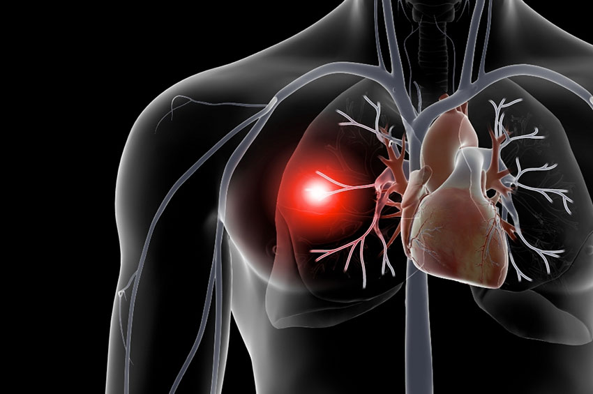 Embolia pulmonar pode ser fatal