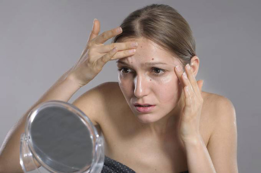 Você tem acne? 