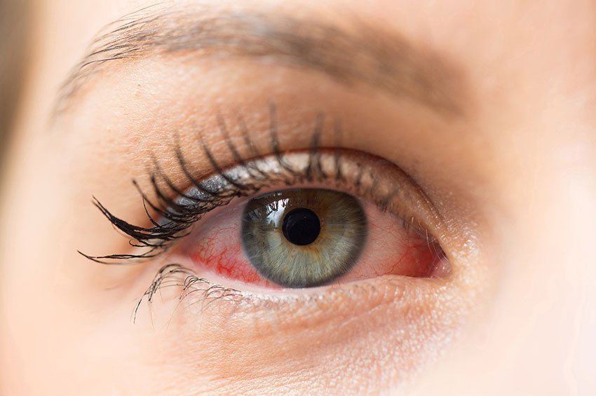 Tempo seco pede atenção com alergias oculares  