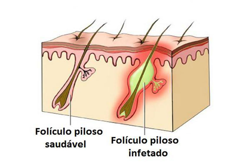 Foliculite: tratamentos estéticos podem ajudar a controlar esse problema