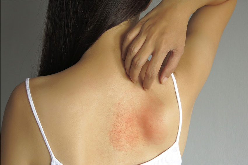 Micose: doença causada por fungos que atingem a pele, as unhas e os cabelos