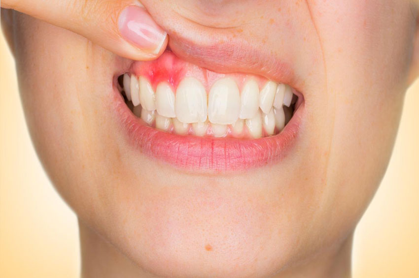 Como evitar inflamação na gengiva?