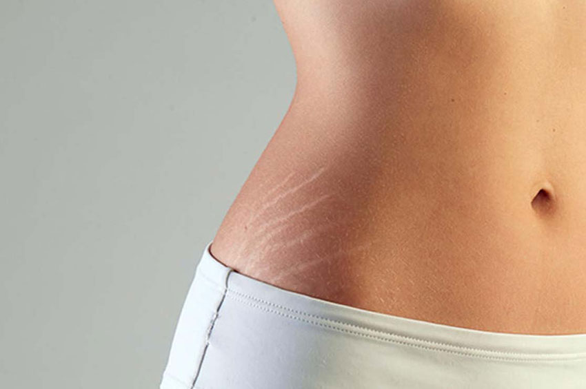 Hidratação da pele ajuda a prevenir e melhorar estrias?