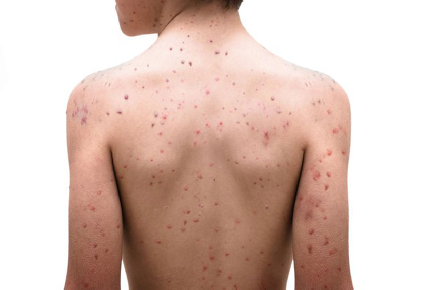 Catapora: Vacinação é a melhor forma de prevenir a doença
