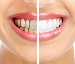 Conheça alimentos e bebidas que prejudicam os dentes