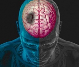 Sonolência e confusão mental podem ser sinais de AVC