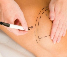 Cirurgia de redução de mamas ? Uma Questão Estética ou de Saúde?