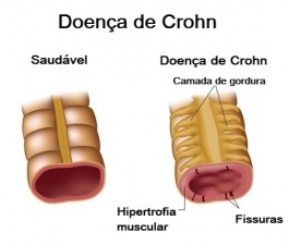 Aprovado novo tratamento para doença de Crohn no Brasil