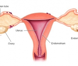 5 Perguntas e Respostas sobre a Cirurgia de Endometriose