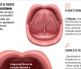 Língua presa tem consequências na amamentação, fala,respiração e até no beijo na boca