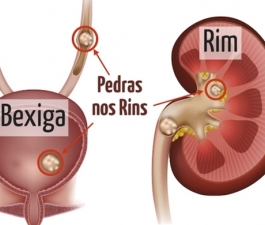 Pedra nos rins: para evitar essa dor, prevenção é palavra de ordem