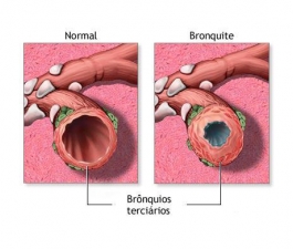 Tempo seco aumenta riscos de bronquiolite