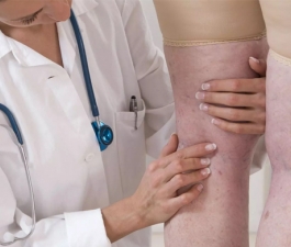 HCor reduz ocorrência de trombose com novo projeto de avaliação de risco e prevenção