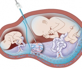 Conheça a síndrome que afeta 15% das gestações de gêmeos que dividem a mesma placenta