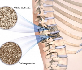 Osteoporose atinge 10 milhões de brasileiros, de acordo com a OMS