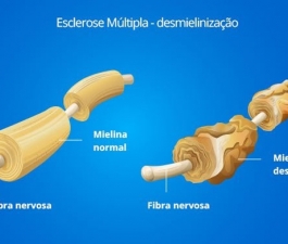 Esclerose Múltipla: doença atinge mais de 2,5 milhões de pessoas no mundo
