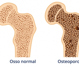 Osteoporose: o que é, causas, sintomas e tratamento