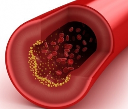 Pouca atenção aos níveis de colesterol pode causar doenças cardiovasculares