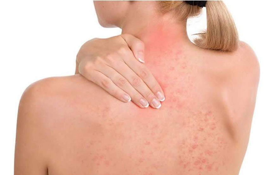 Sociedade Brasileira de Dermatologia faz campanha de conscientização sobre a psoríase